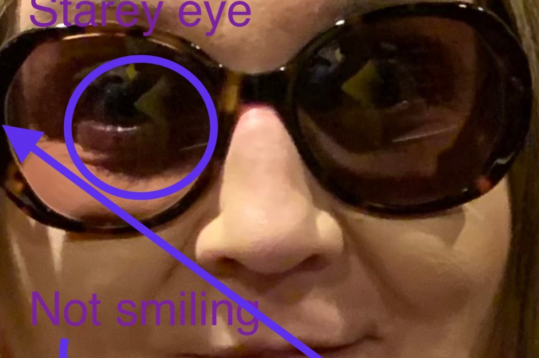 Bell’s palsy is&nbsp;brutal